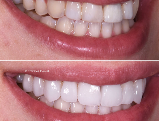 Emirates Dental – Cosmetic Dentistry & Invisalign Clinic Dubai