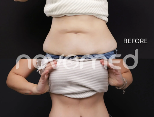 Novomed Plastic Surgeon Dubai Rhinoplasty BBL Liposuction Gynecomastia Tummy tuck Facelift Breast body lift Butt filler Botox