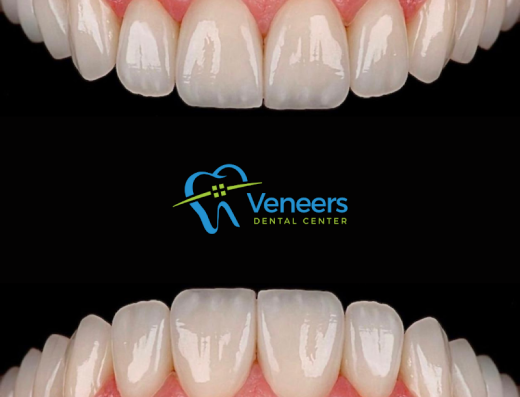 Veneers Dental Centre
